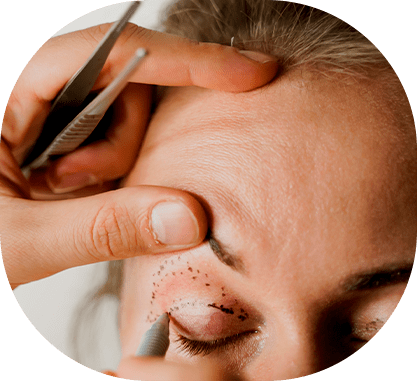 blefaroplastia