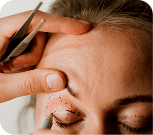 Blefaroplastia