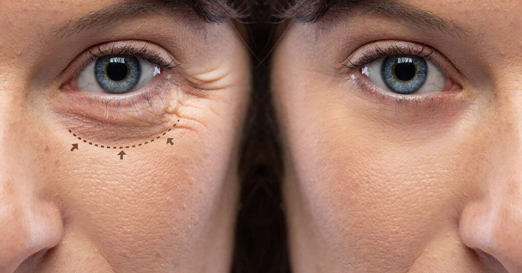 Blefaroplastia