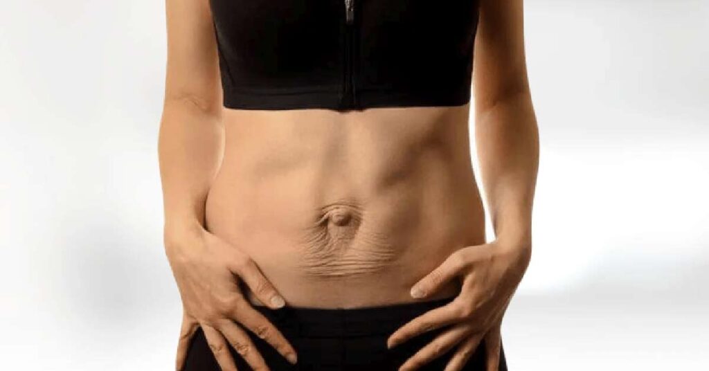 Diástase Abdominal