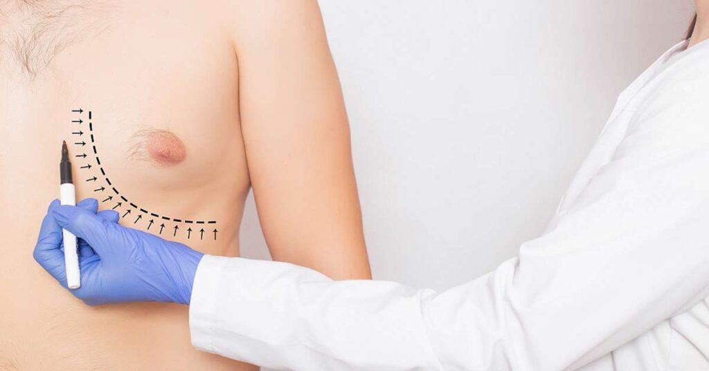 Mamoplastia em Homens