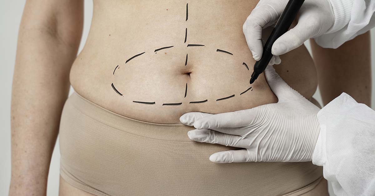 Abdominoplastia x miniabdominoplastia: quais as diferenças e indicações?