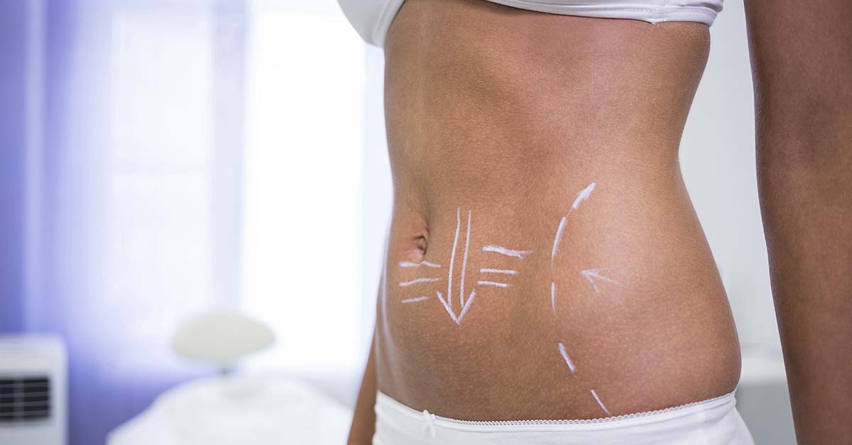 Lipoaspiração HD ou tradicional: qual a melhor técnica para o seu corpo?